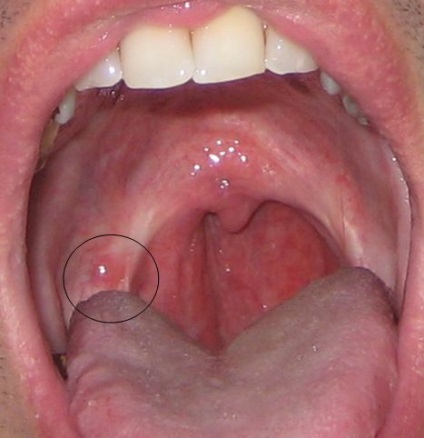 Herpesul dureros în gât (tratament, simptome), cum este tratată amigdalita herpetică