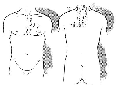 Hirudoterapia cu angină pectorală