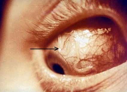 Viermii în ochii parazitilor în ochi și cum să le tratăm