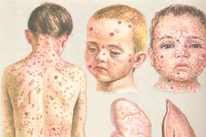 Puricent varicelă - cauze, simptome, forme și tratament, articole pe