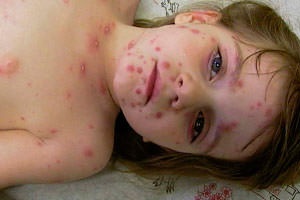Puricent varicelă - cauze, simptome, forme și tratament, articole pe