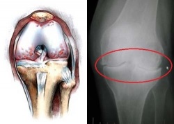 Gonartroza articulației genunchiului