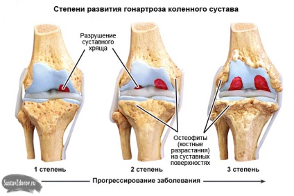 Osteoarthritis a térdízület 1 fok okai, tünetei és kezelése