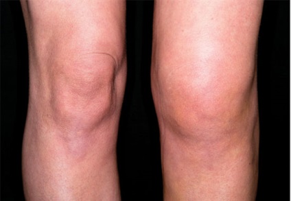 Gonartroza articulațiilor genunchiului cu 1 grad, simptome și tratament