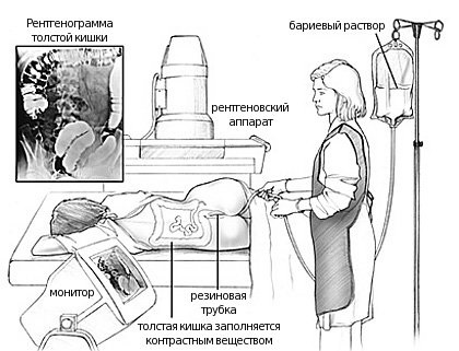 Irrigoscopia din Chelyabinsk - diagnosticarea bolilor