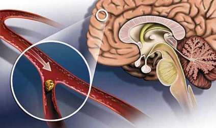 Accident vascular cerebral ischemic - leziuni extinse, drepte și cerebulare