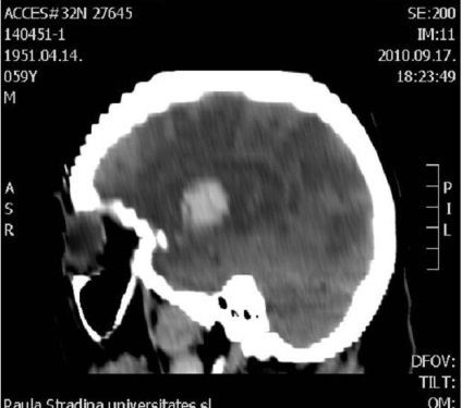 Accident vascular cerebral ischemic - leziuni extinse, drepte și cerebulare
