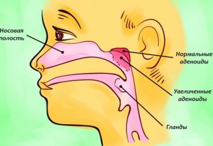 Ce simptome de adenoizi la un copil necesită tratament unui medic