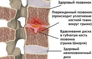 Cum să tratați o hernie a coloanei vertebrale lombare
