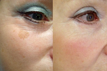 Cum să îndepărtați fața pigmentată de pe față de acasă