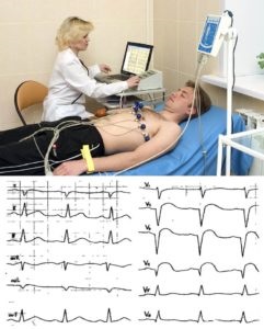 Cardioscleroza cauze, tipuri, simptome, diagnostic, tratament