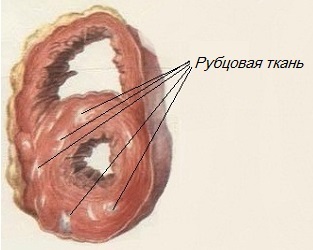 Cardioscleroza cauze, tipuri, simptome, diagnostic, tratament