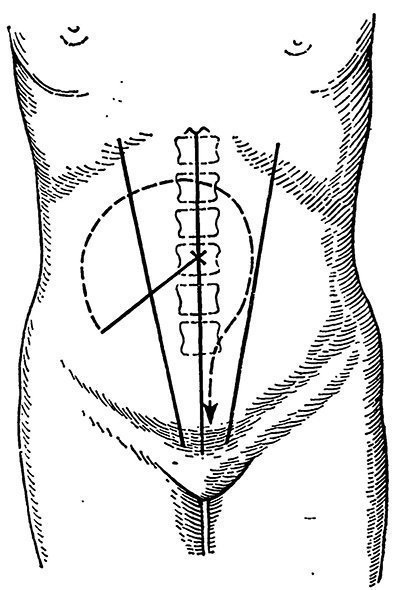 Obstrucție intestinală