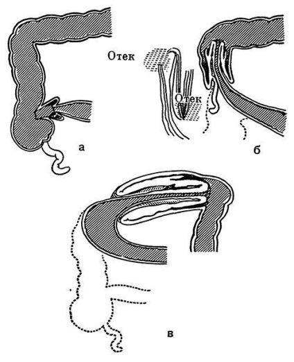 Obstrucție intestinală