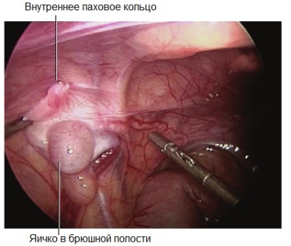 Clinica Bilyak - tratamentul criptorhidismului