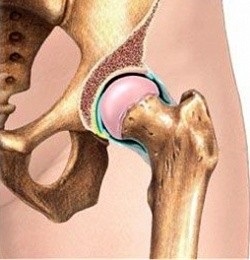 Coxarthrosis kezelés, a tünetek, okoz -, mint egy élvezet