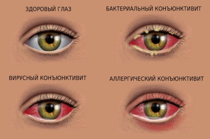 Conjunctivita tratament pentru ochi la adulți, picături, simptome, virală