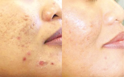 Tratamentul cu laser al acneei și post acneei