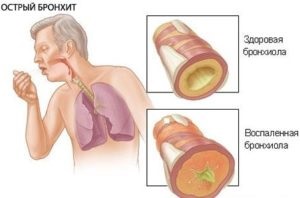 Exerciții terapeutice cu bronșită