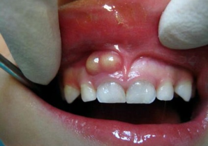 A kezelés fluxus elsődleges fogak gyermekek módszerek, okozza a