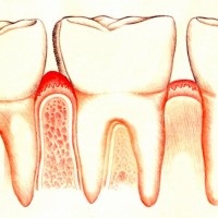 Tratamentul și simptomele gingivitei la copii sub 2 ani, tratament dentar
