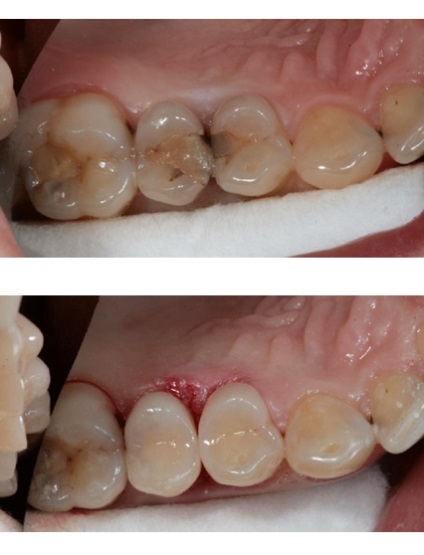 Tratamentul cariilor dentare, preturi, numire