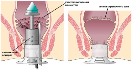 Tratamentul prolapsului rectocel și pelvian, Donetsk, centru de chirurgie și laparoscopie