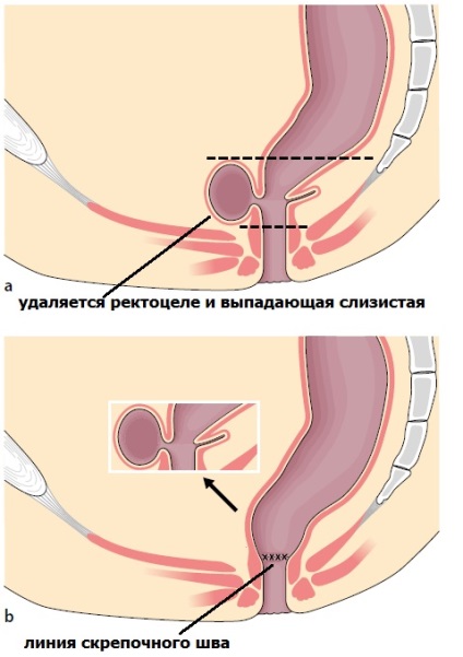 Tratamentul prolapsului rectocel și pelvian, Donetsk, centru de chirurgie și laparoscopie