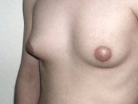 Lipomastia, ginecomastie falsă la bărbați - cauze, tratament, fotografie