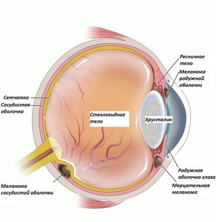 Melanomul retinei oculare, prognostic, metode și mijloace, cauze, diagnostic