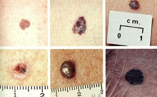 Melanomul (melanomul) pielii - ce este, este curabil, etapele