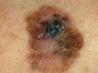 Melanomul (melanomul) pielii - ce este, este curabil, etapele