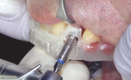Implantare minim invazivă în zona estetică - implantologie - știri și articole pe