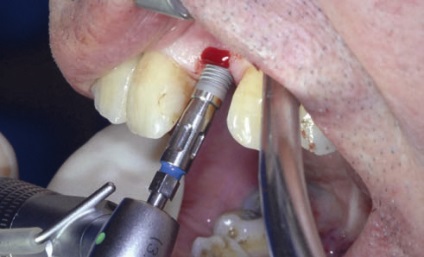 Implantare minim invazivă în zona estetică - implantologie - știri și articole pe