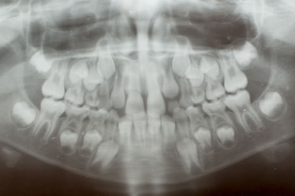 Dinții bebeluși sunt ... adulți! Cazul dentar Ce să faceți