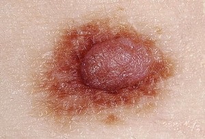 Pot vindeca melanomul cum să se vindece?