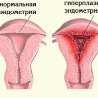 Medicină tradițională pentru hiperplazia endometrială - bisturiu - medical