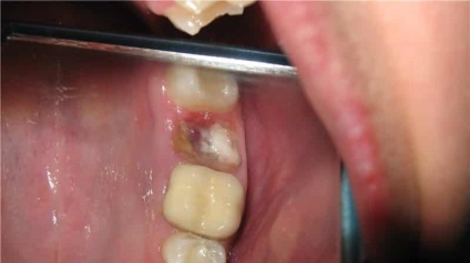 Miros neplăcut din gură după o înțelepciune de extracție a dinților