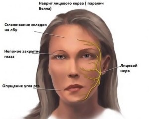 Nevrita cauzată de nervul facial, simptomele, metodele de tratament