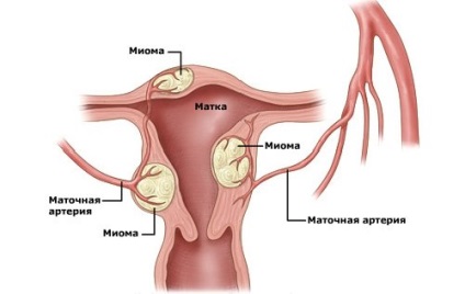 Caracteristicile construcției complexului cu miome uterine