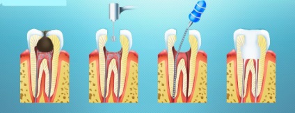 Tratamentul cu pulpită focală acută, diagnostic, clinică