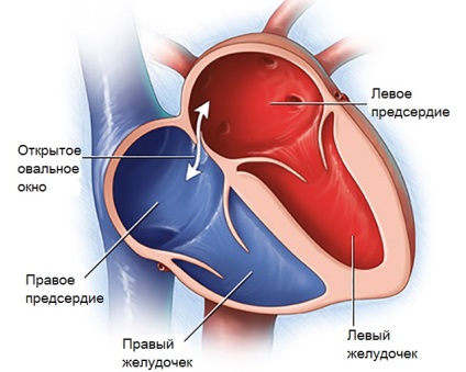 Fereastra ovală deschisă în patologia inimii și normă