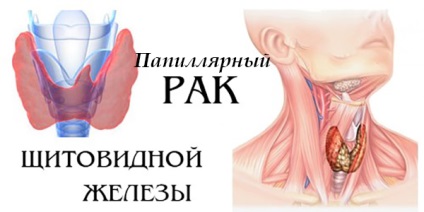 Папиларен рак на щитовидната жлеза симптоми, прогнозата след операция