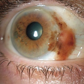 Glaucomul pigmentar