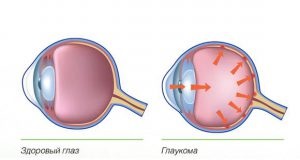 Pigment glaukóma prognózis, kezelés, a tünetek