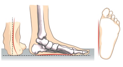 Плоско стъпало - причини, симптоми и лечение
