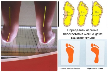 Aplatizarea simptomelor și a tratamentului la adulți și copii