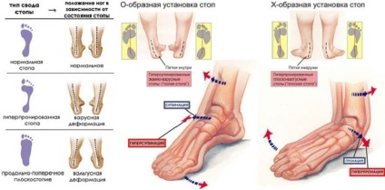 Aplatizarea simptomelor și a tratamentului la adulți și copii