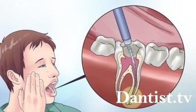 După o durere de dinți, ce să faceți, cauzele și tratamentul