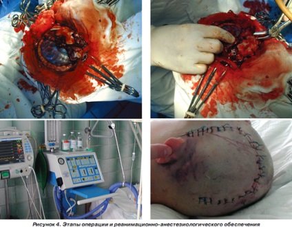 Infarct miocardic post-traumatic la un copil cu traumatisme cranio-cerebrale severe, ediție online